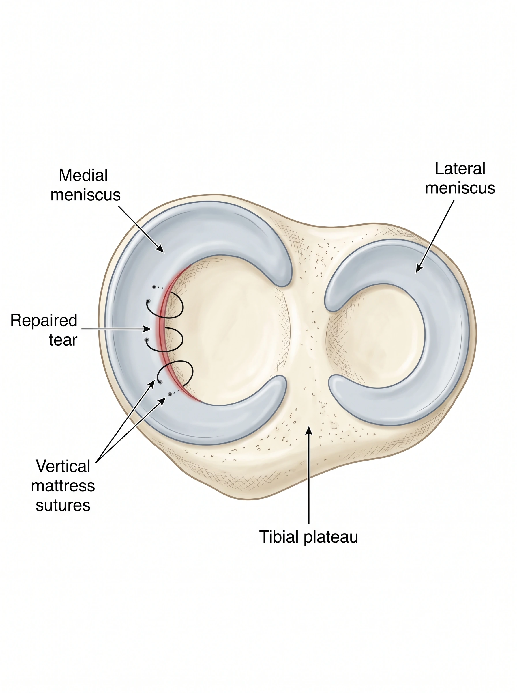 Medical illustration of Meniscus Repair
