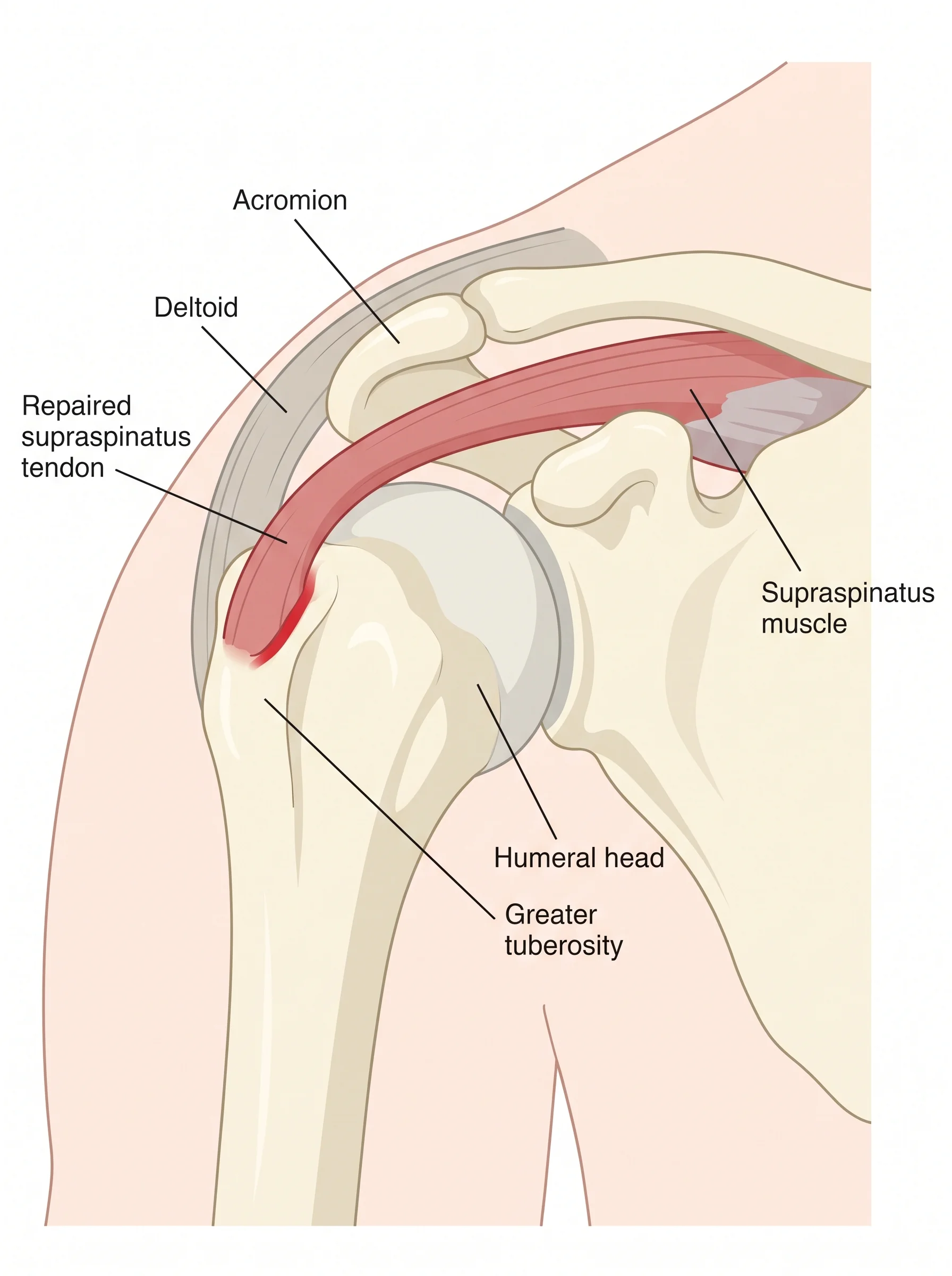 Medical illustration of Rotator Cuff Repair