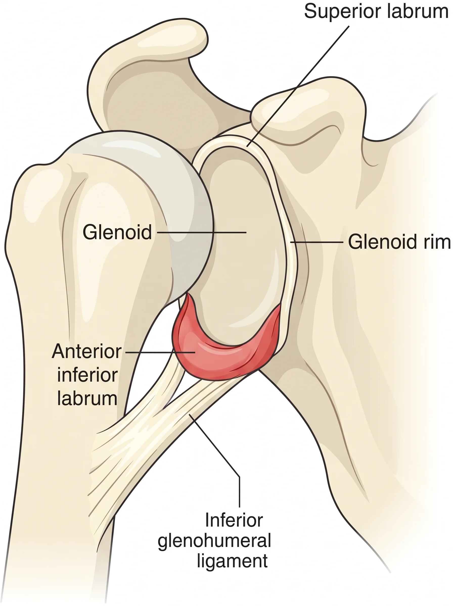 Medical illustration of Bankart Repair (Stabilization)