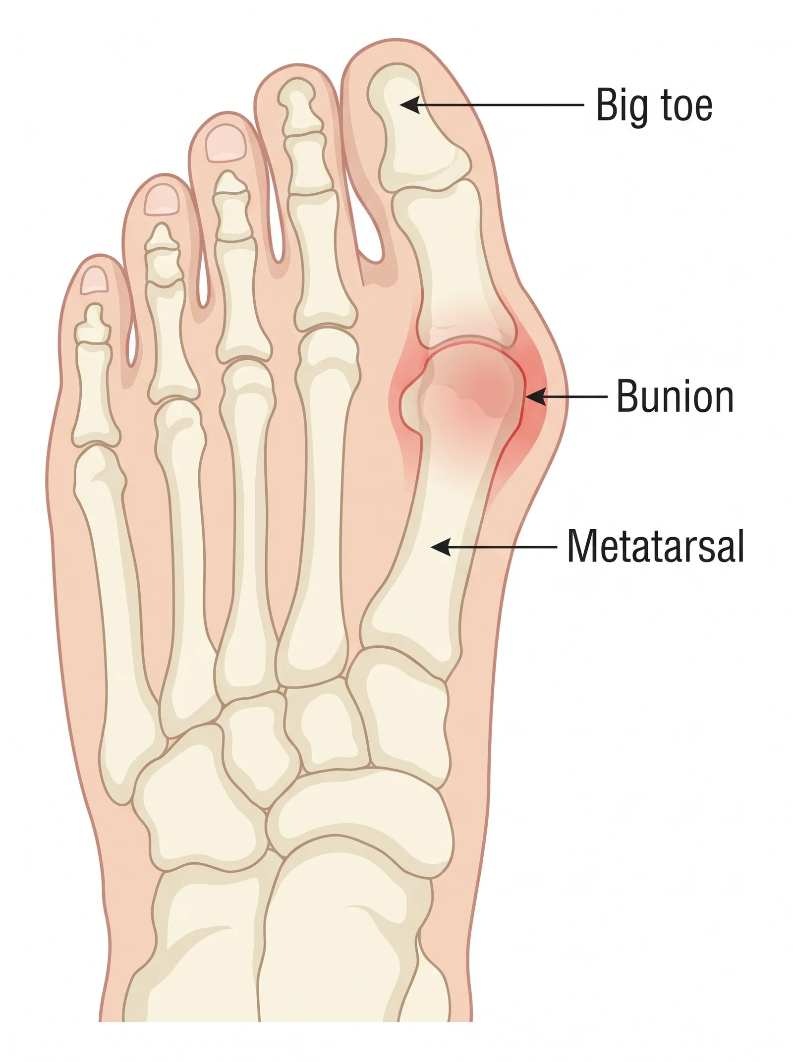 Labeled medical illustration of bunions