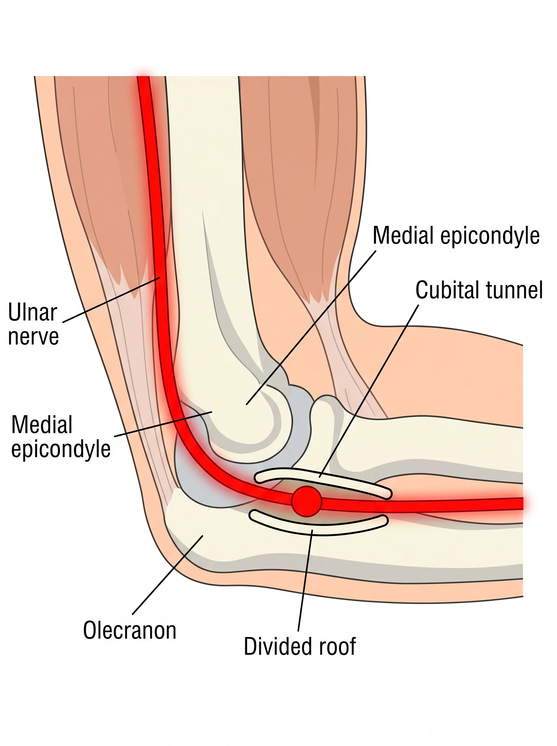 Medical illustration of Cubital Tunnel Release
