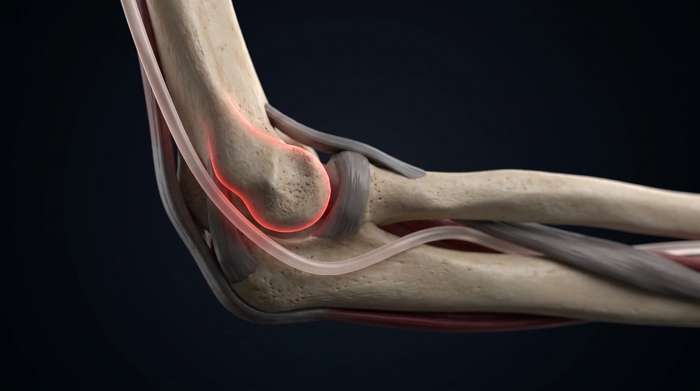 Medical illustration of Cubital Tunnel Release