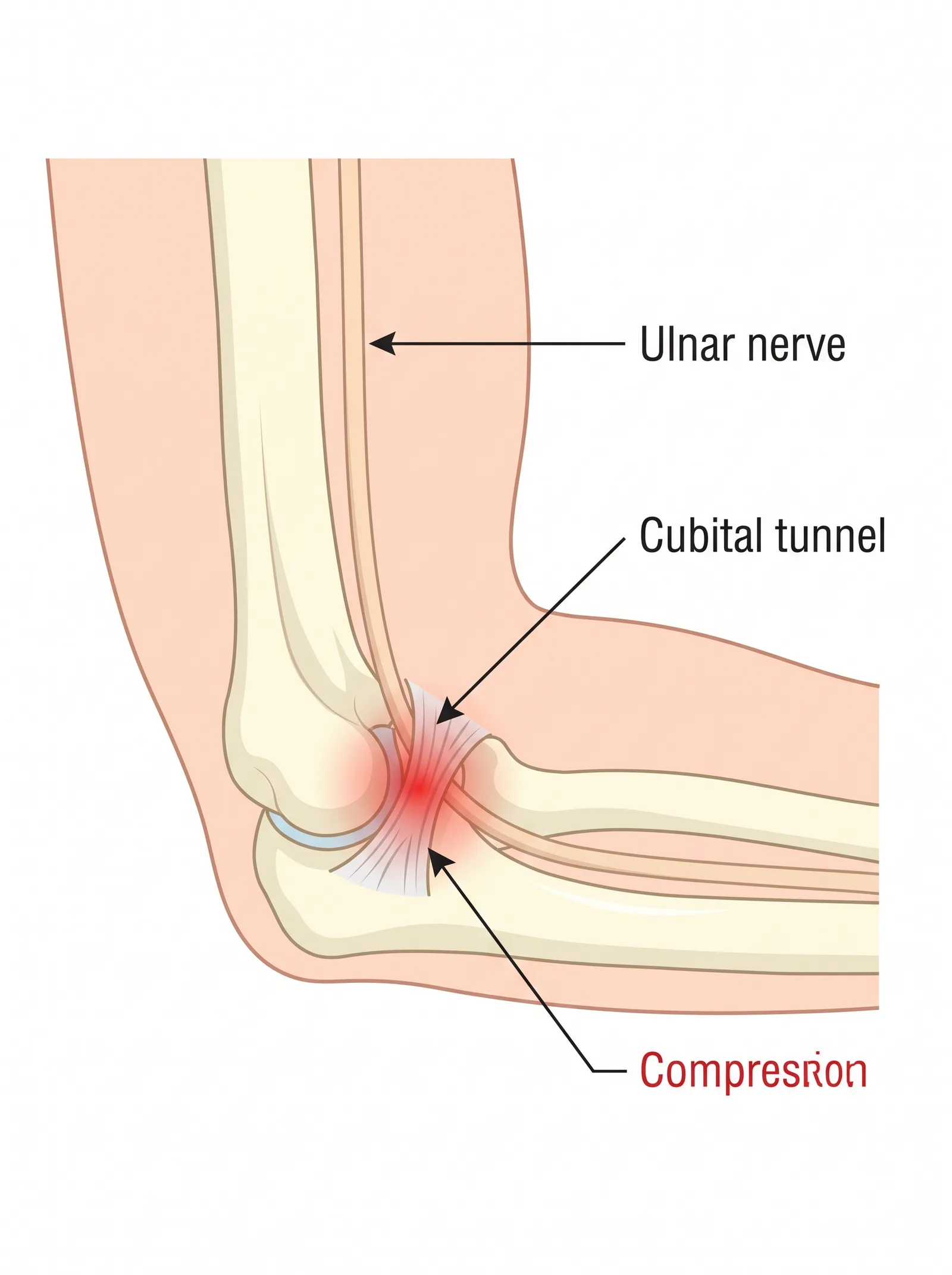 Labeled medical illustration of cubital tunnel syndrome