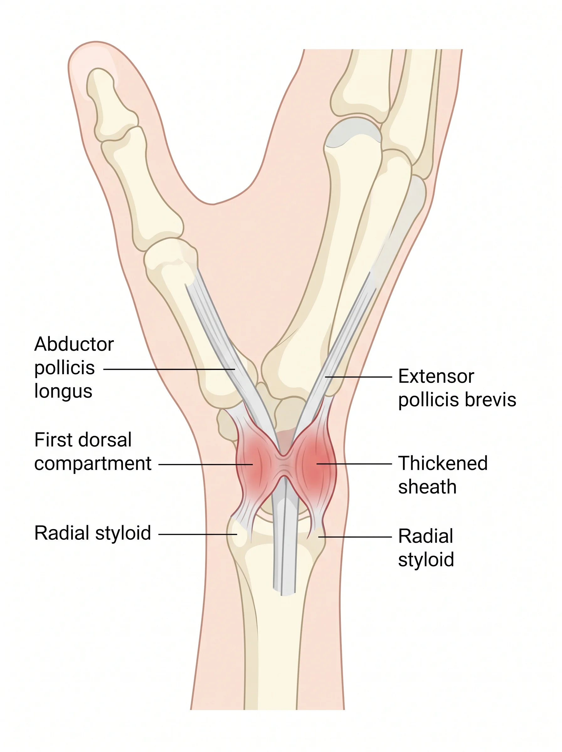 Medical illustration of De Quervain's Tenosynovitis