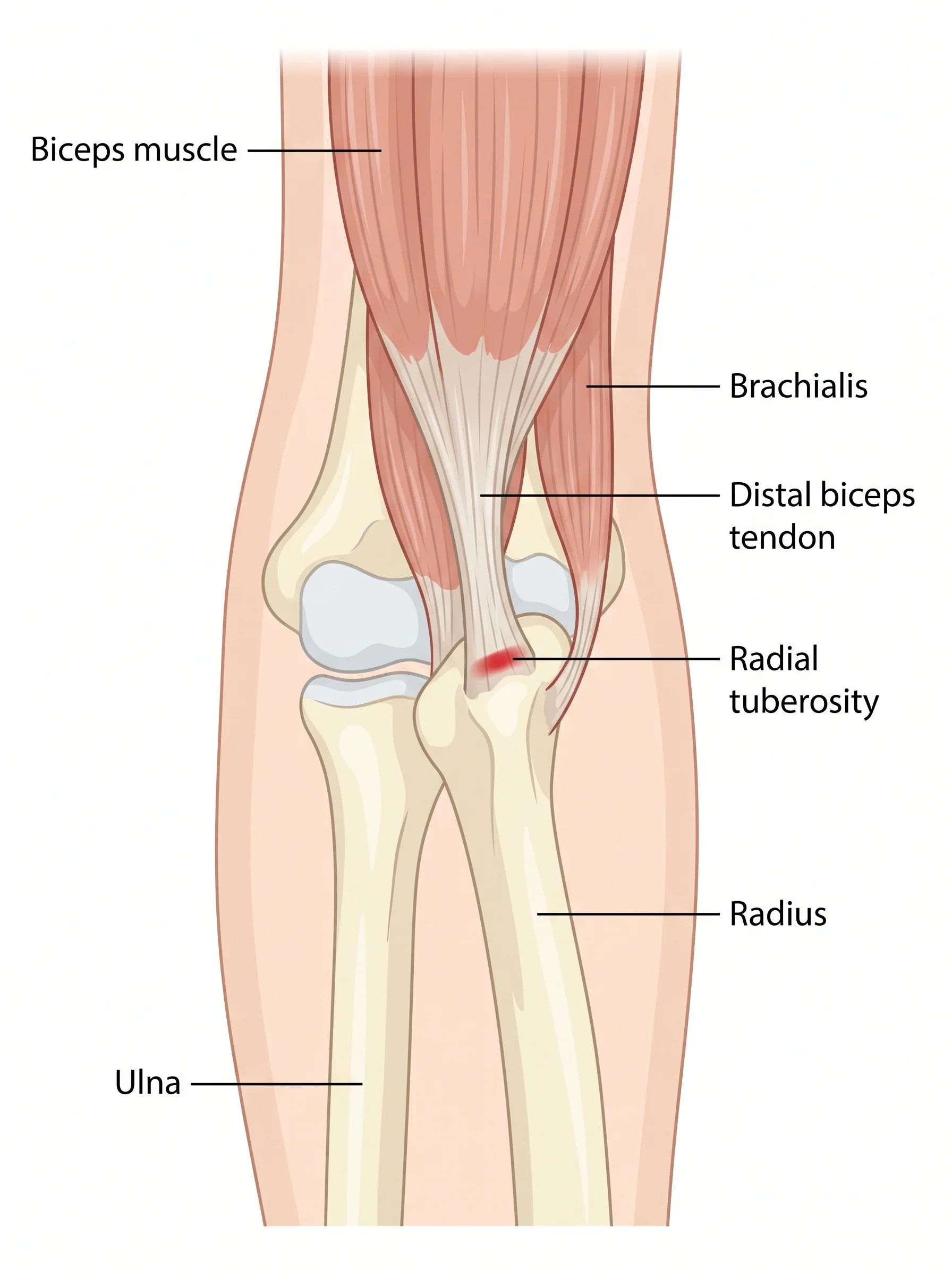 Medical illustration of Distal Biceps Repair