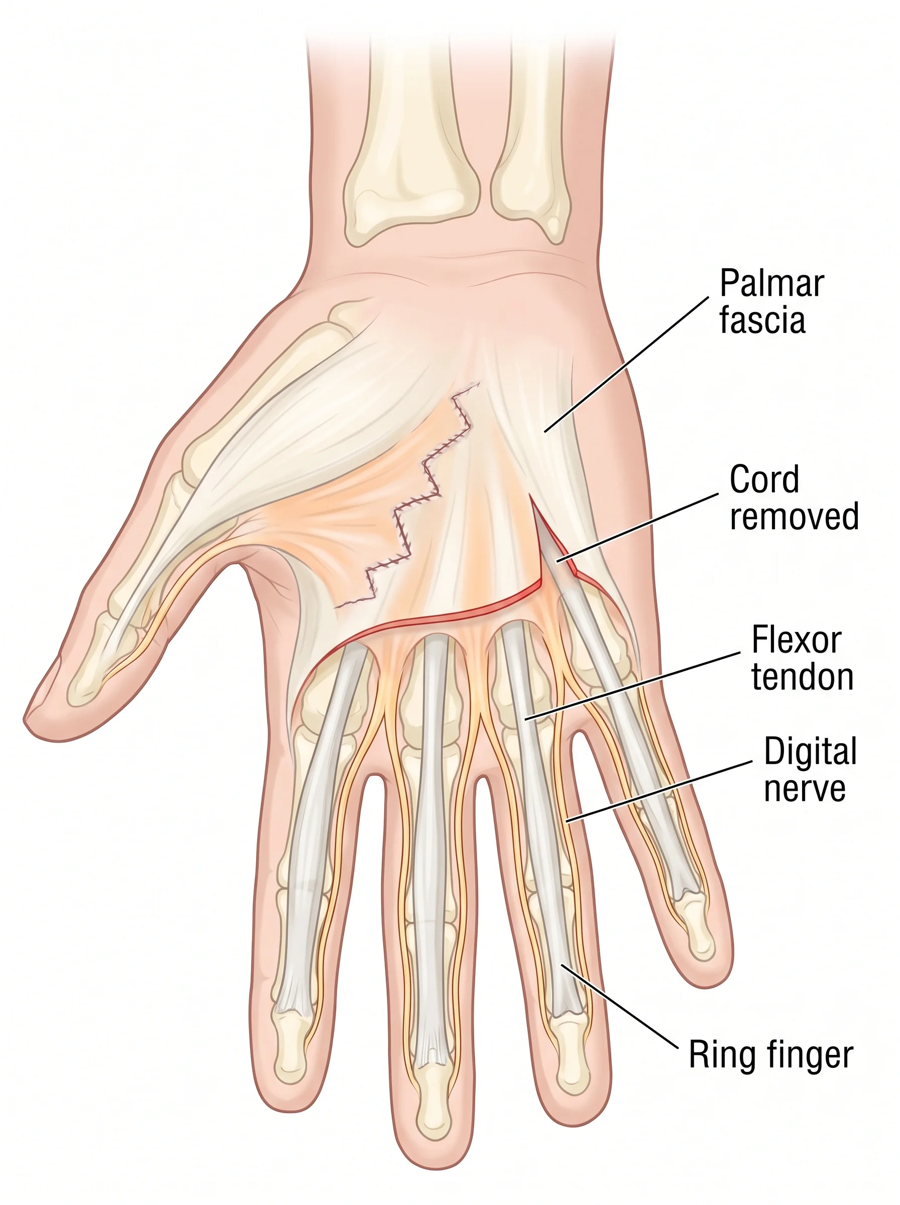 Medical illustration of Dupuytren Release