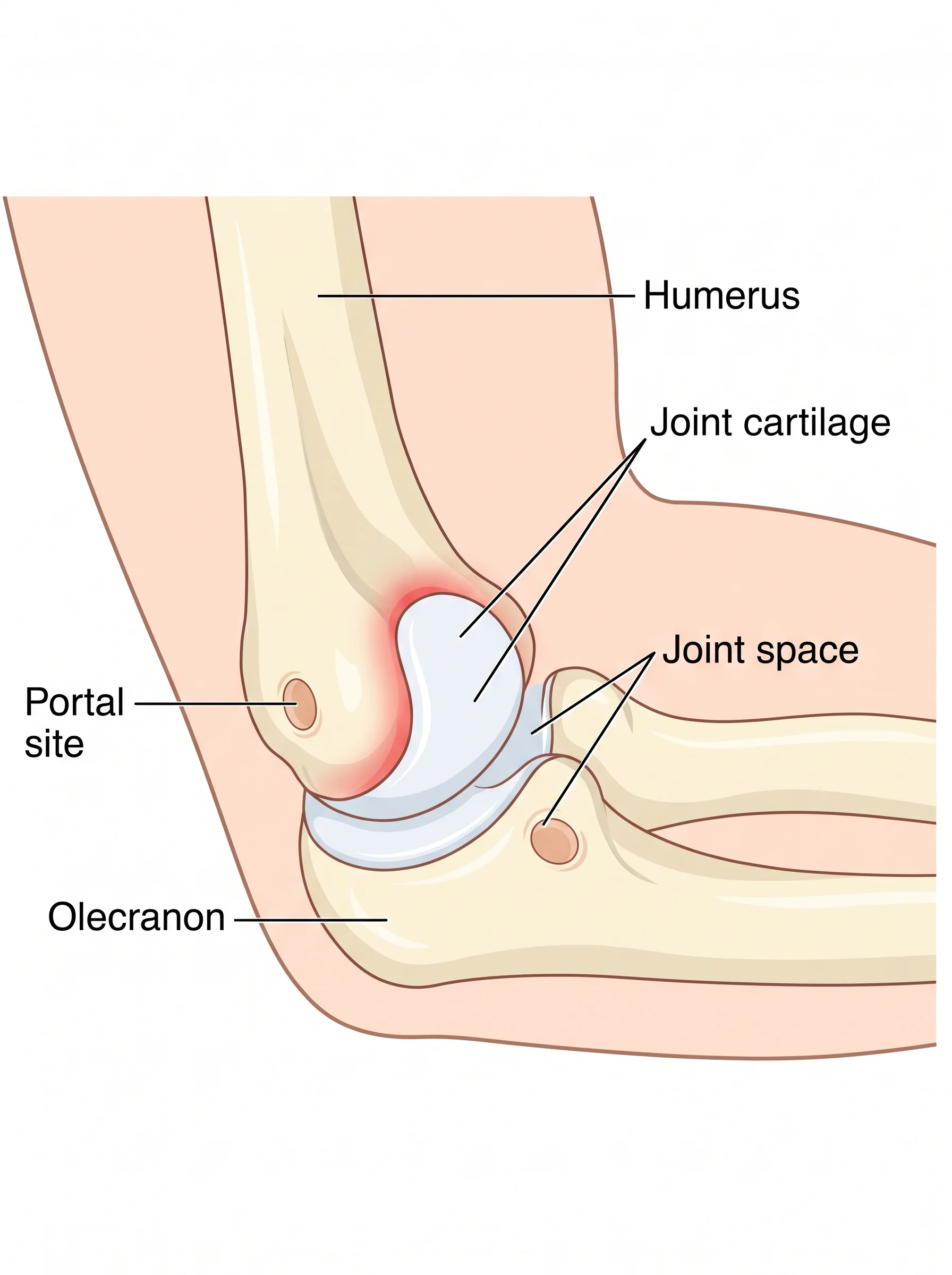 Medical illustration of Elbow Arthroscopy