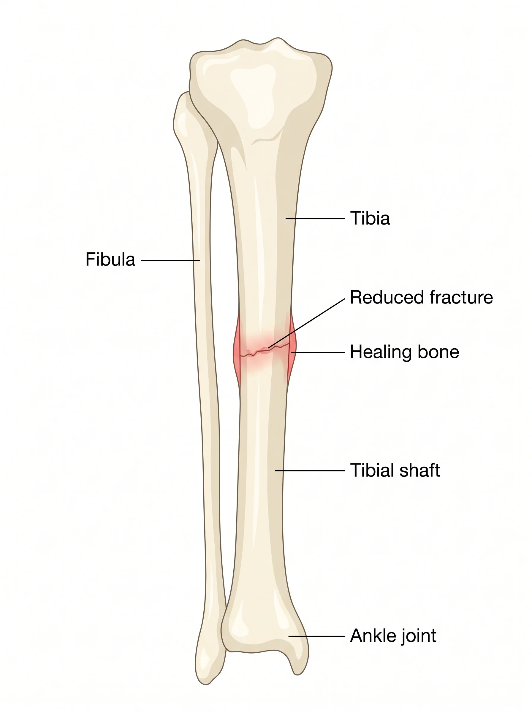 Medical illustration of Fracture Repair (ORIF)