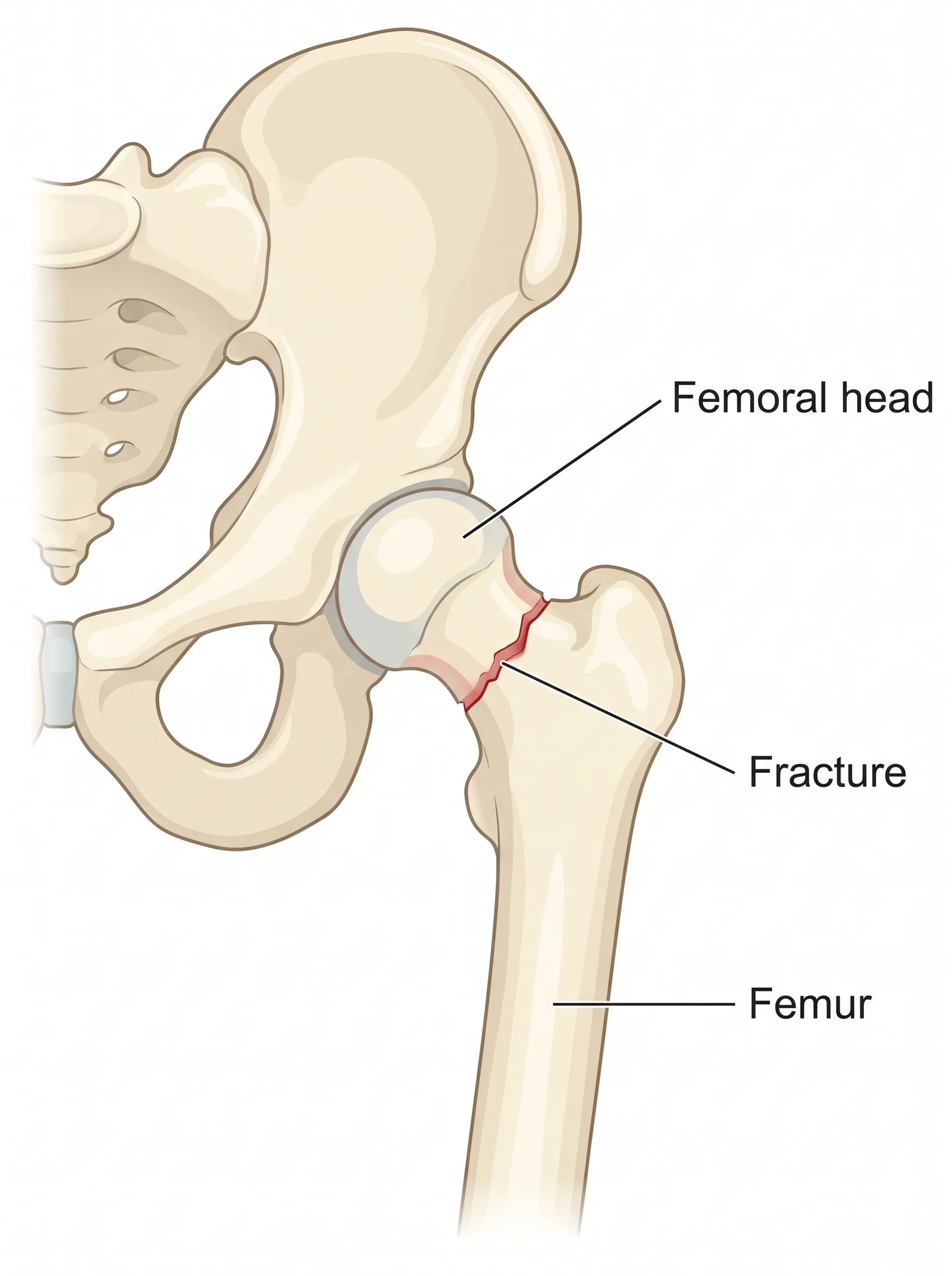 Labeled medical illustration of fractures broken bones