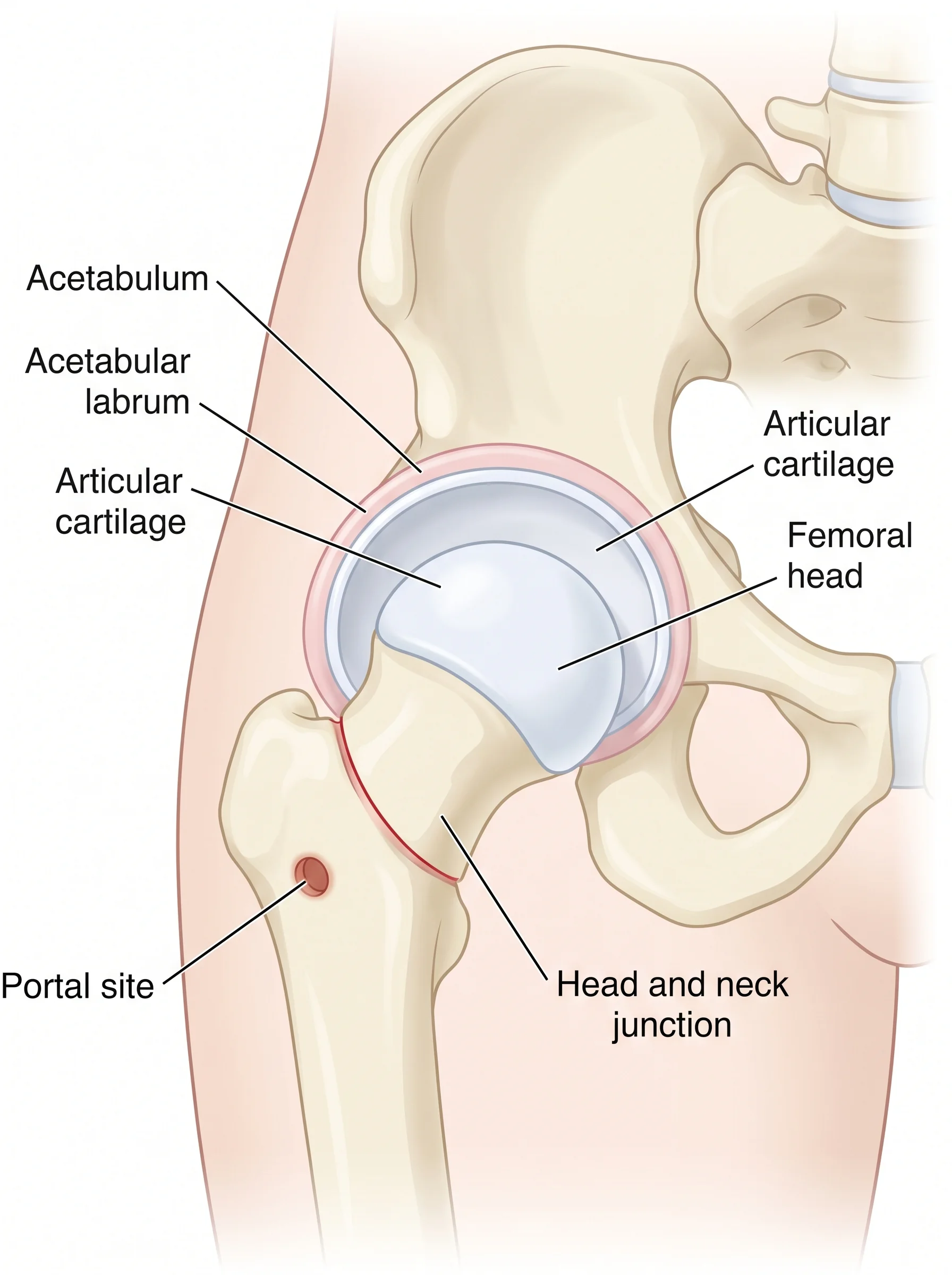 Medical illustration of Hip Arthroscopy: a complete guide