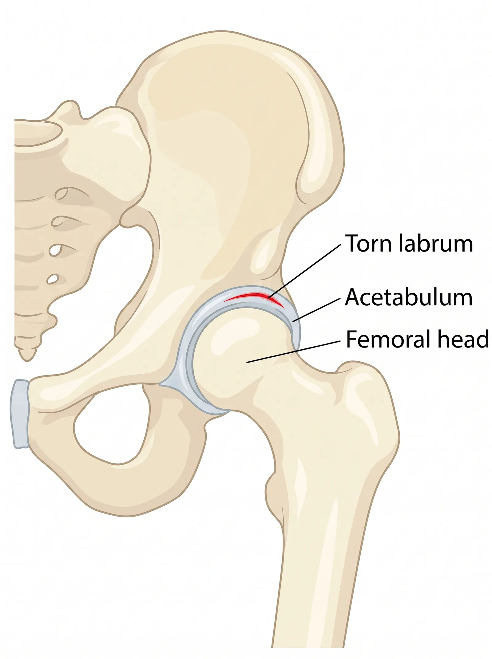 Labeled medical illustration of hip labral tear