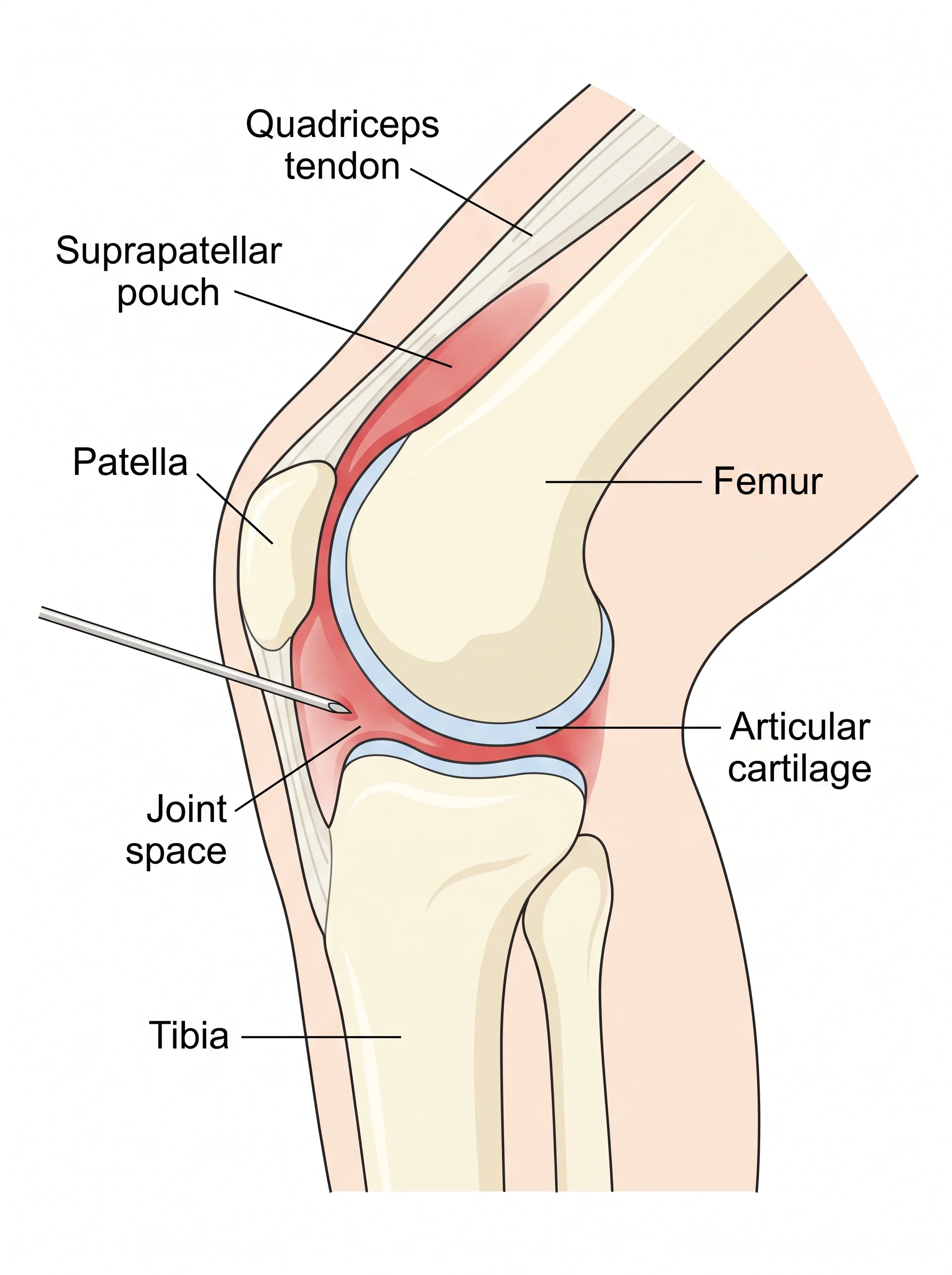 Medical illustration of Joint Injections (Cortisone/PRP)