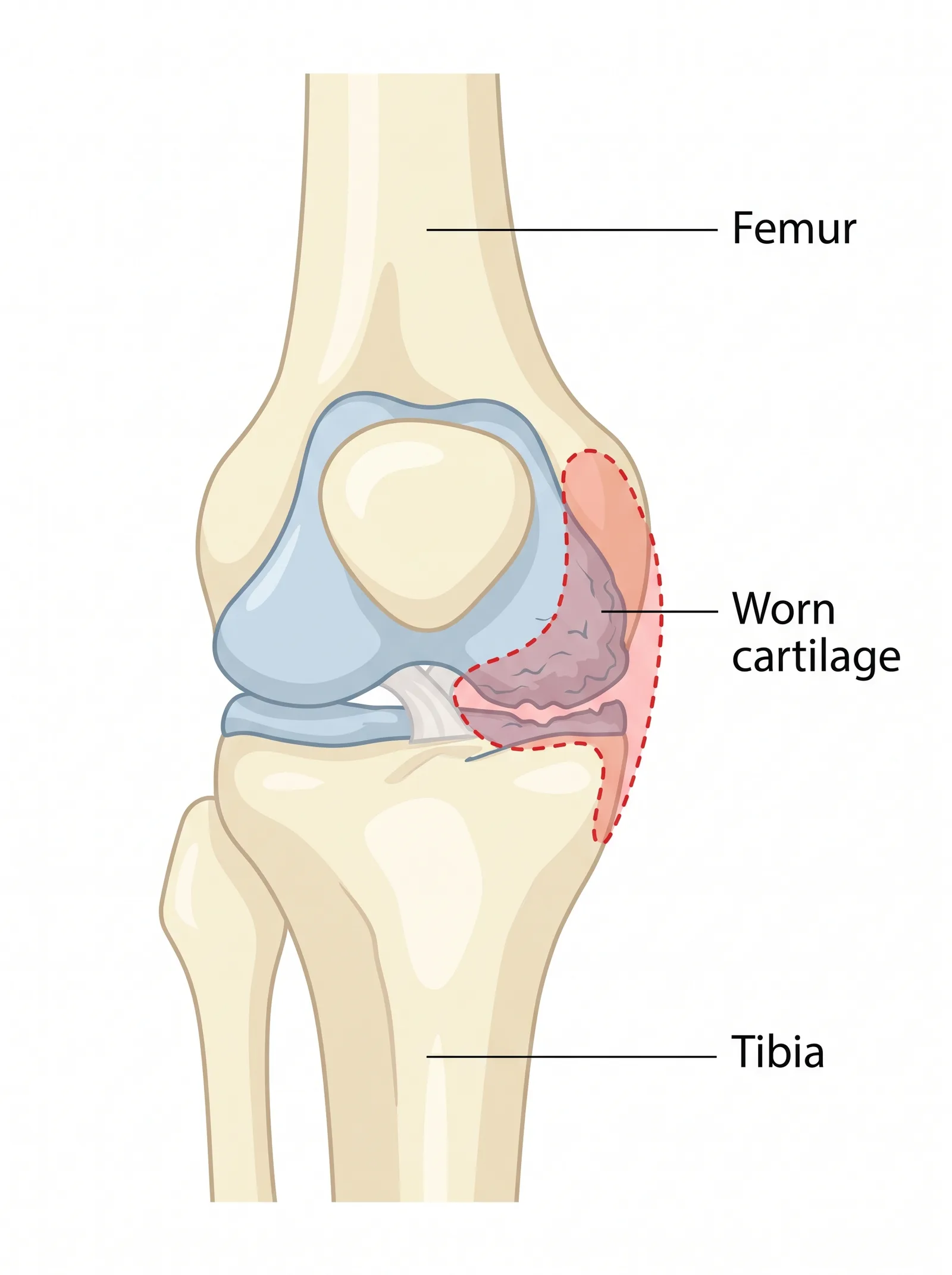 Labeled medical illustration of knee osteoarthritis