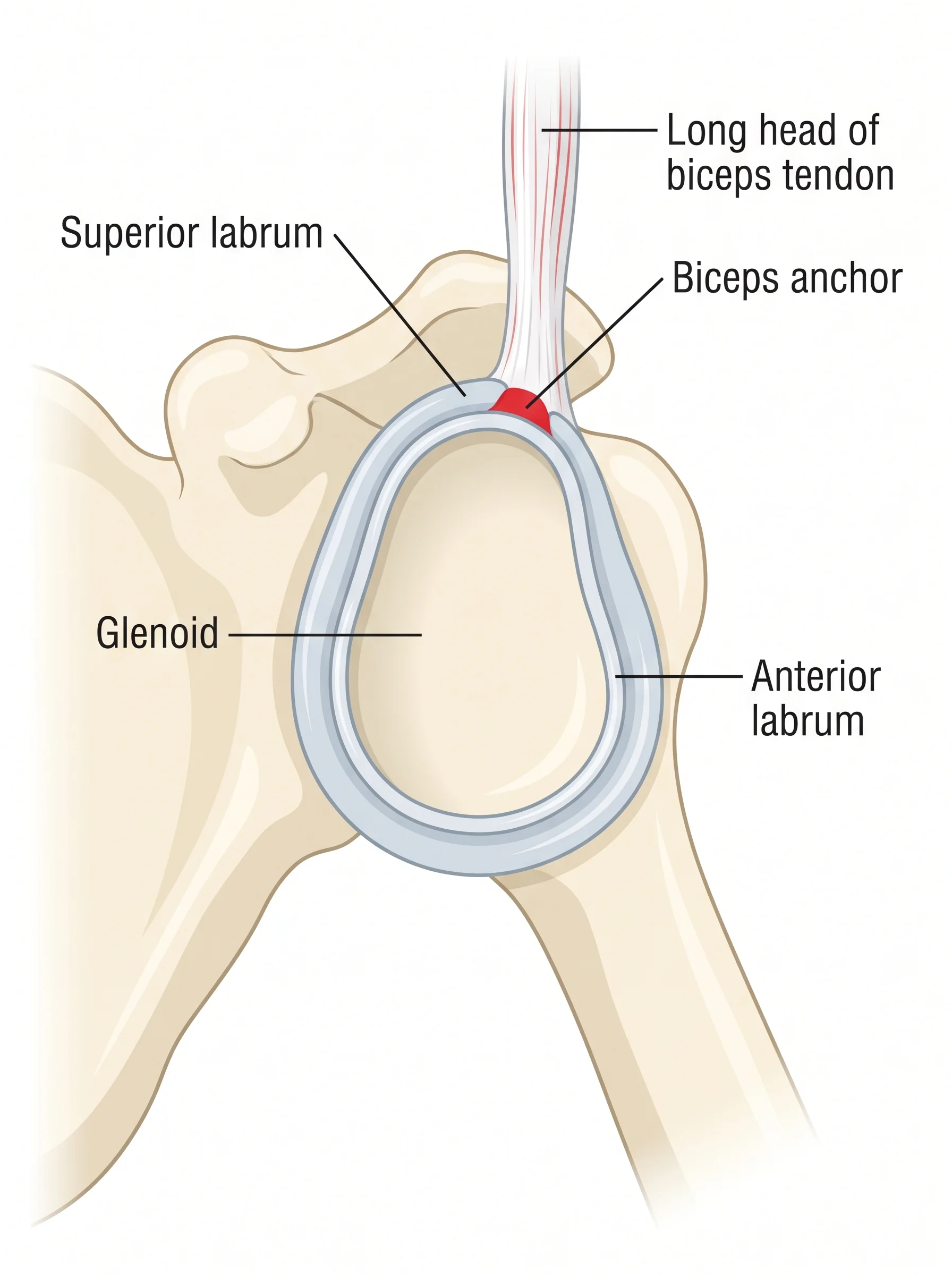 Medical illustration of Shoulder Labral / SLAP Repair