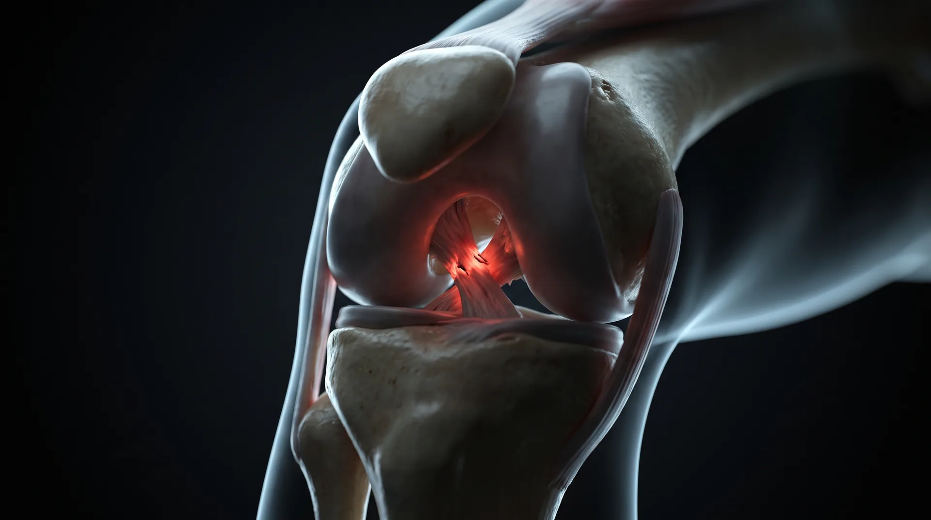 Medical illustration of Multi-Ligament Knee Reconstruction