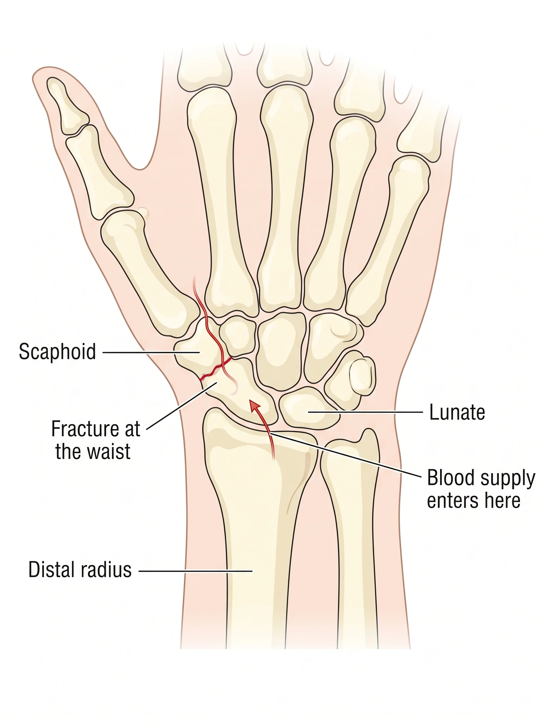 Medical illustration of Scaphoid Fracture