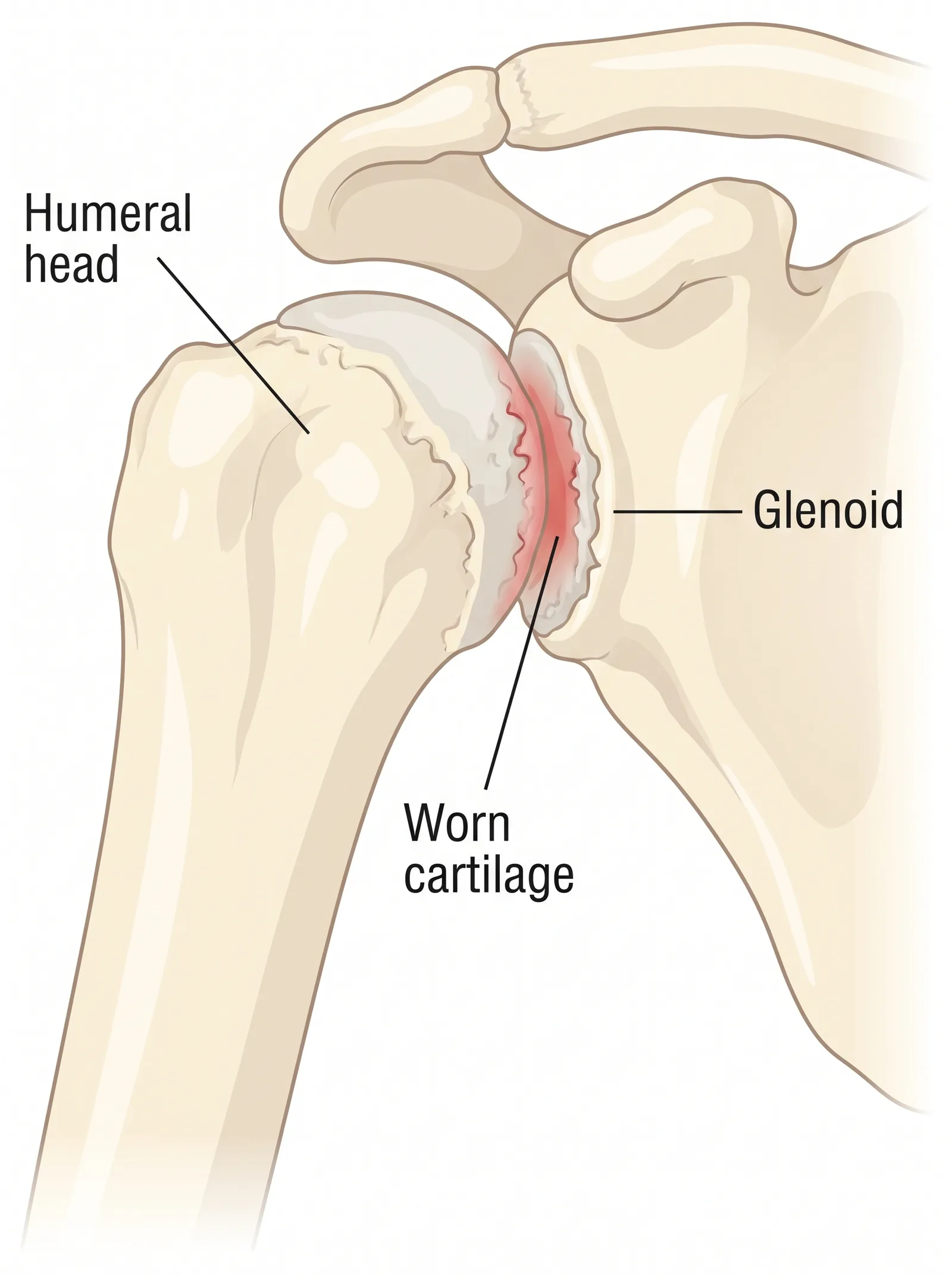 Labeled medical illustration of shoulder osteoarthritis