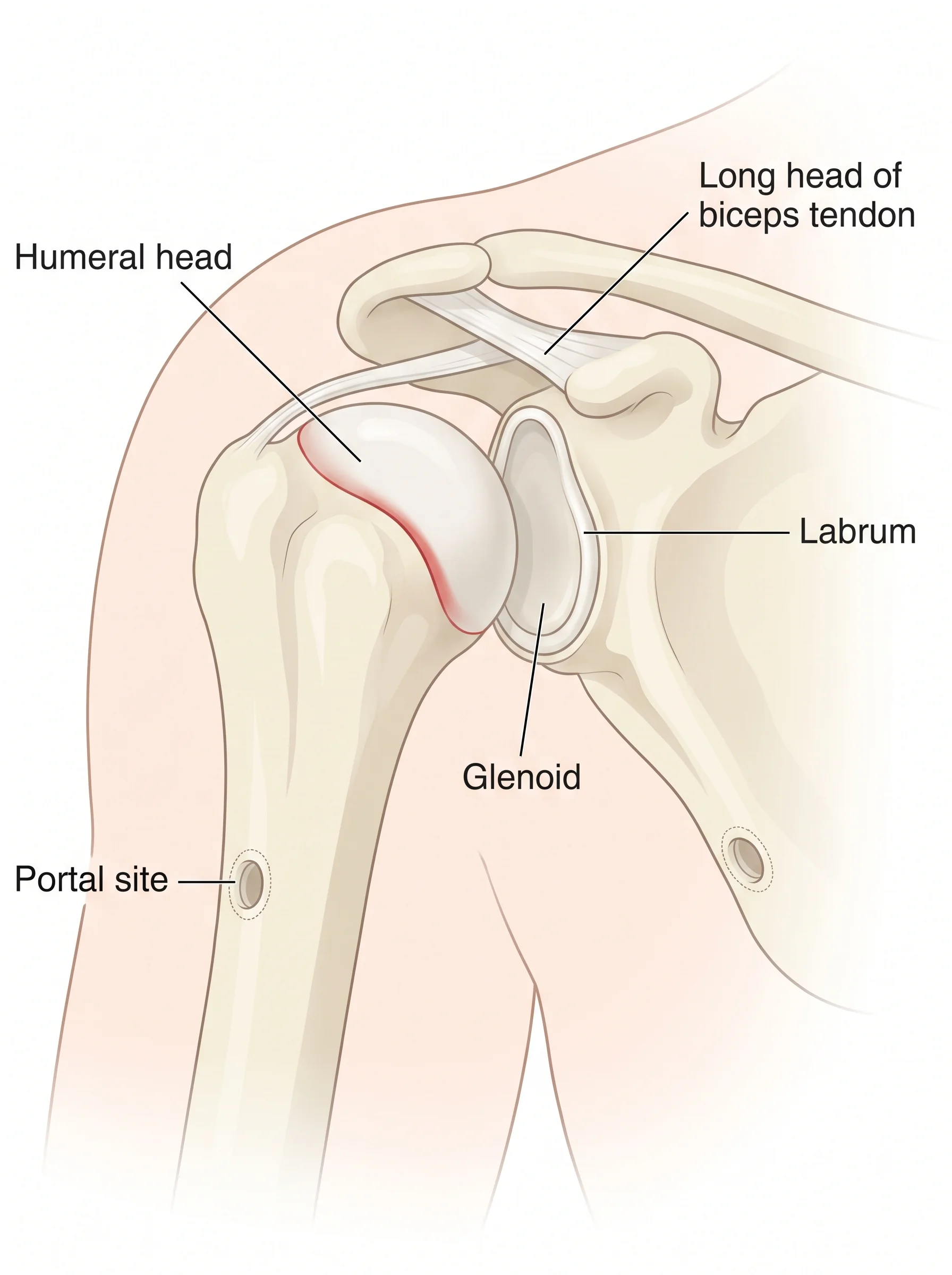 Medical illustration of Shoulder Arthroscopy
