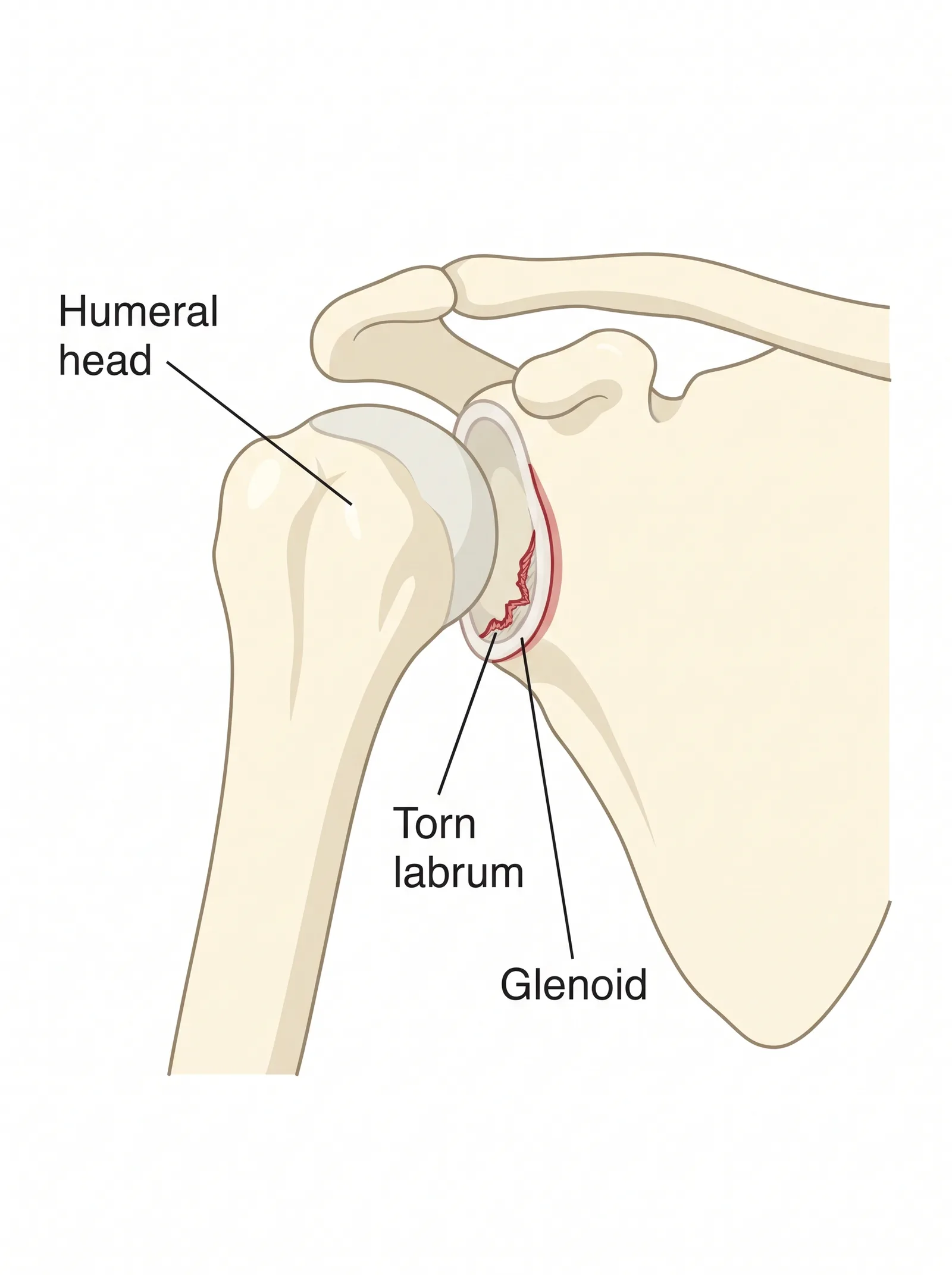 Labeled medical illustration of shoulder instability / dislocation