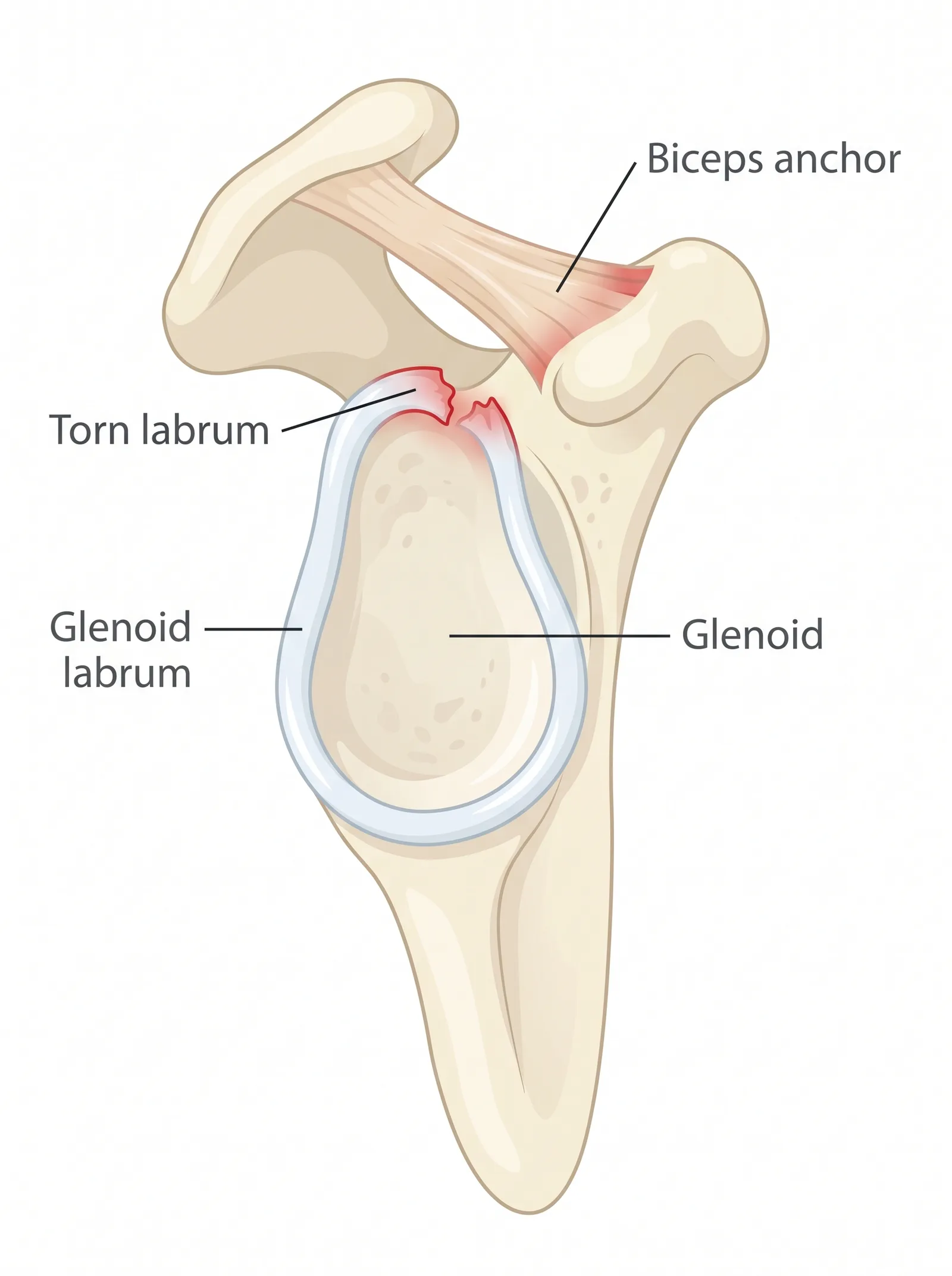 Labeled medical illustration of slap tear and labral tear