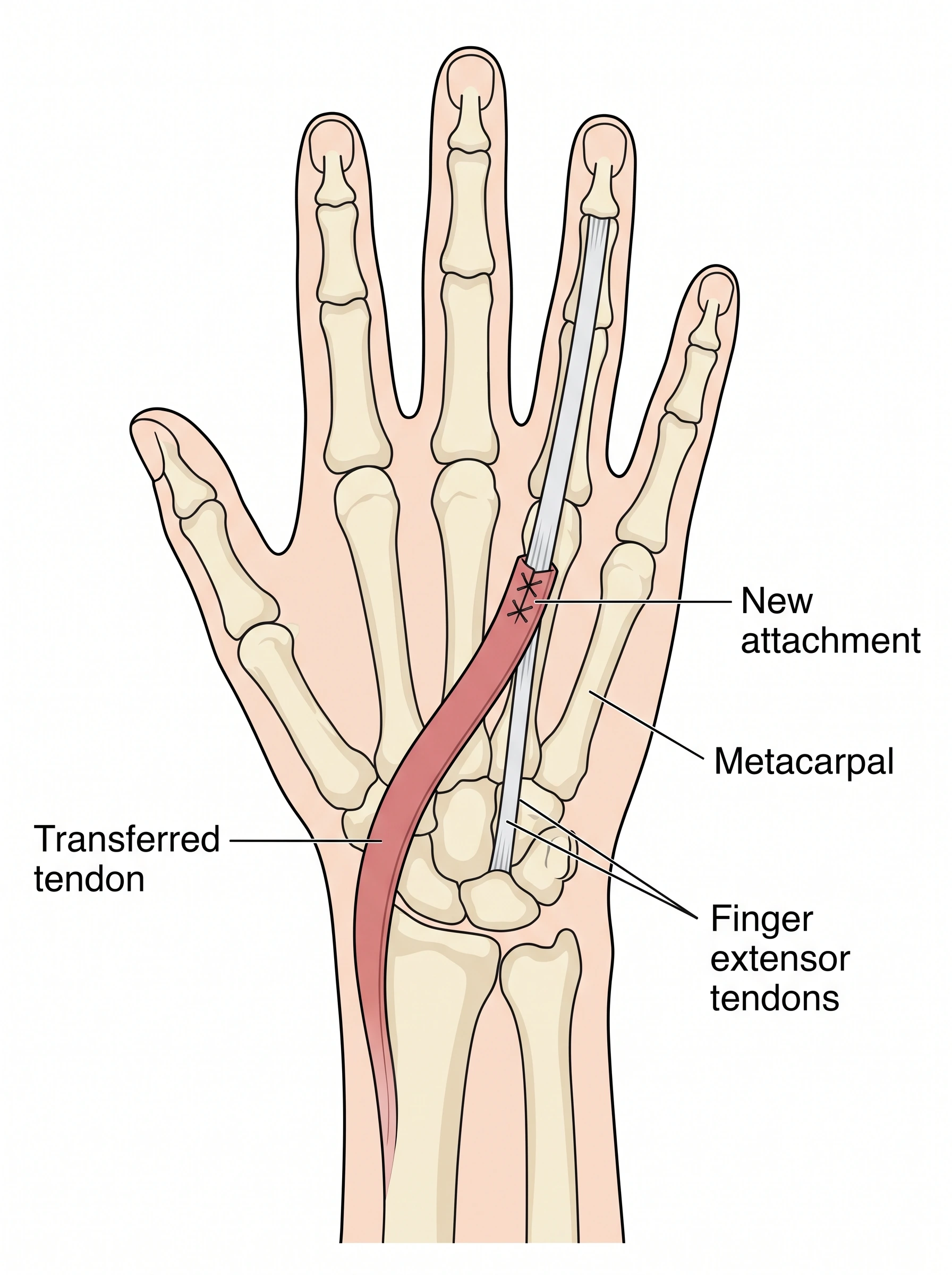 Medical illustration of Tendon Transfer