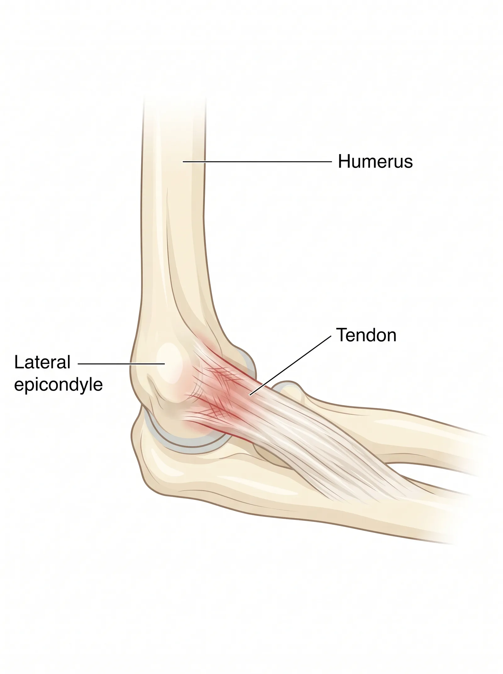 Labeled medical illustration of tennis elbow