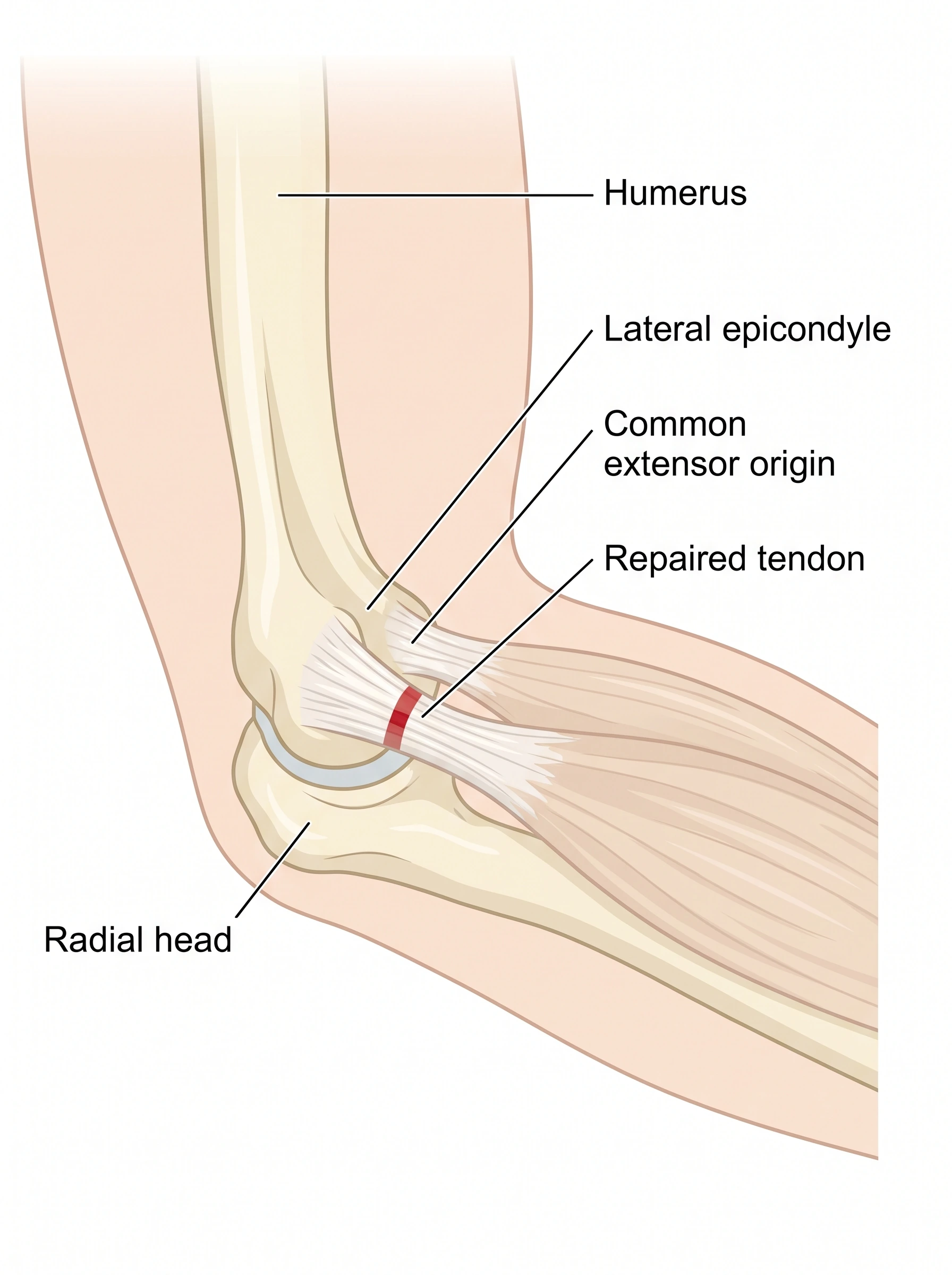 Medical illustration of Tennis Elbow Release