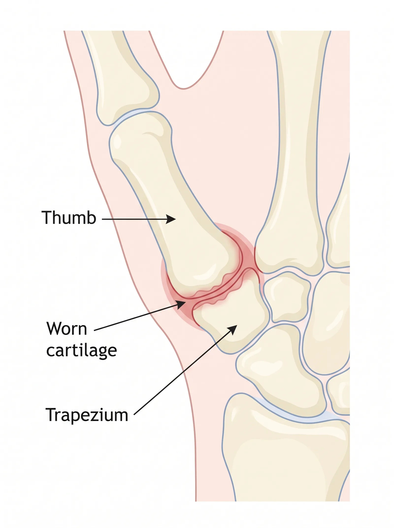 Labeled medical illustration of thumb cmc arthritis