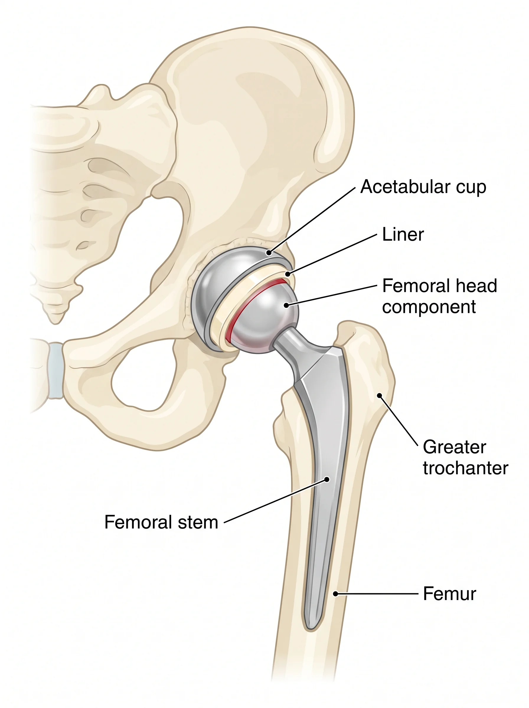 Medical illustration of Total Hip Replacement