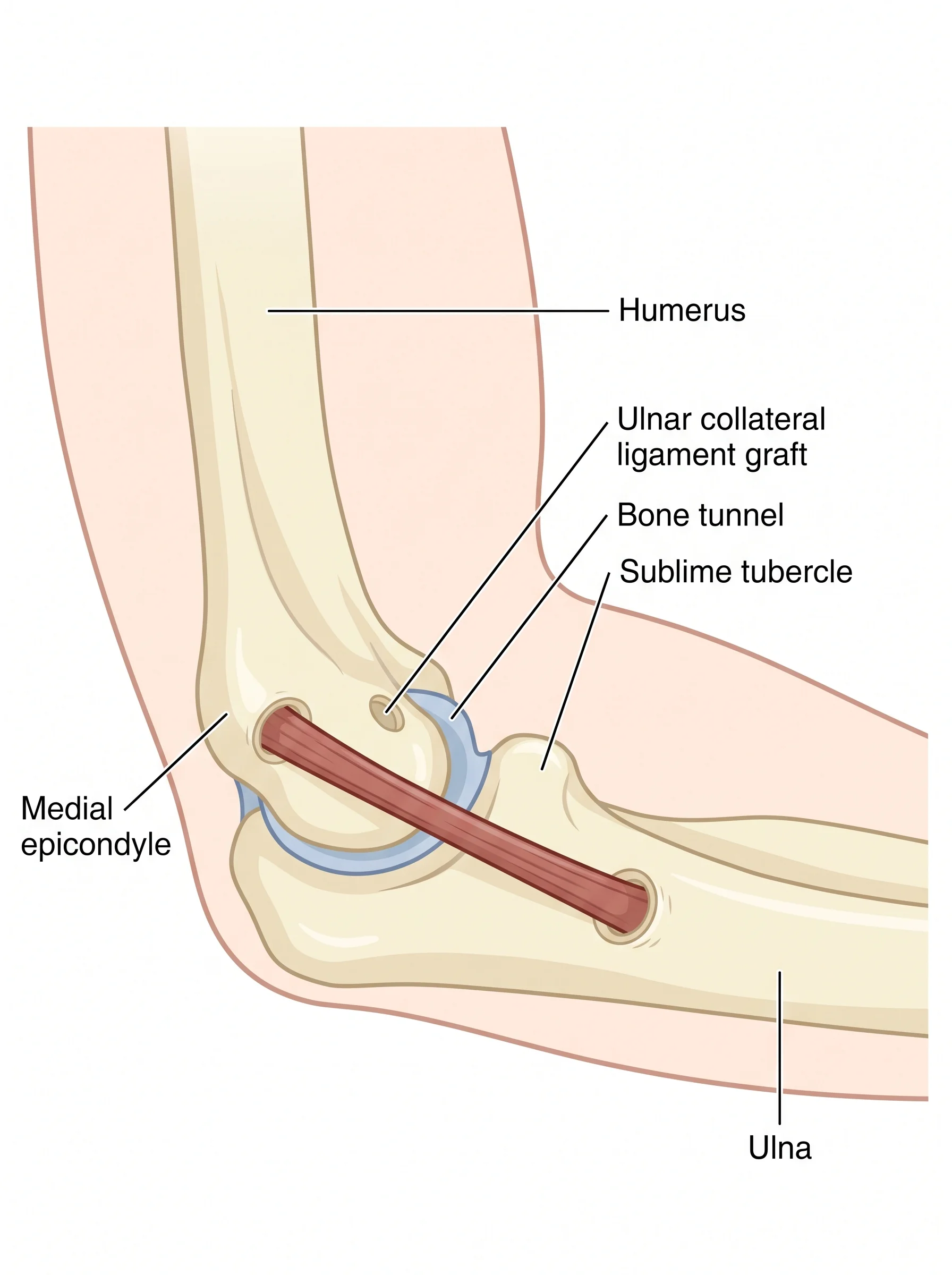 Medical illustration of UCL Reconstruction (Tommy John)
