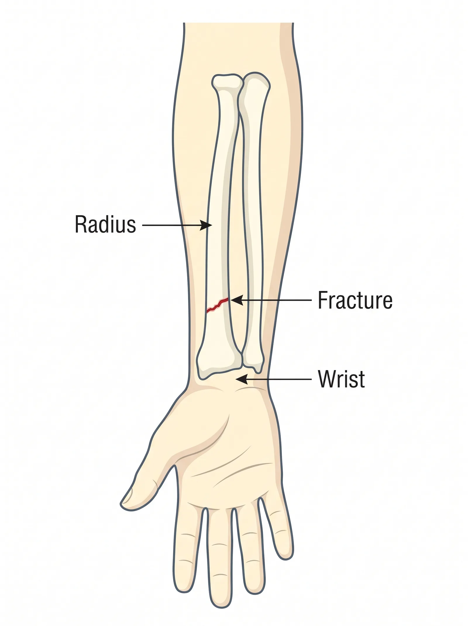 Labeled medical illustration of distal radius wrist fracture